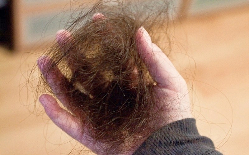 гормоны отвечающие за рост волос у женщин на голове