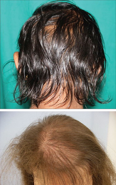 Мужчины реже обращают внимание на поредение волос на голове