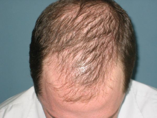 Пример диффузного выпадения волос у мужчины