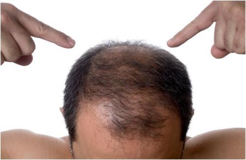 Как восстановить волосы у мужчин в домашних условиях. Лечение облысения у мужчин