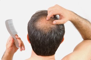 Выпадение волос у мужчин лечение