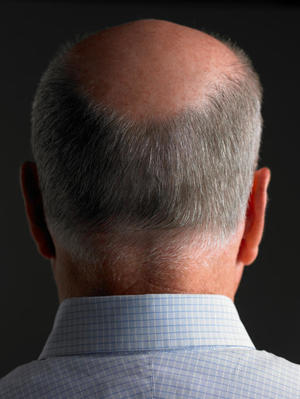 Почему выпадают волосы на голове у мужчин