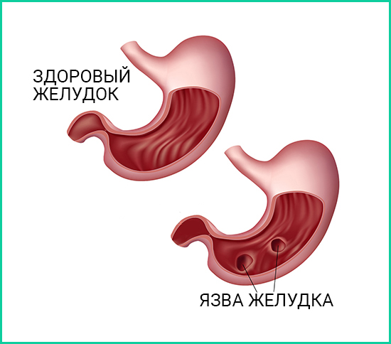 Язва желудка лечение народными средствами