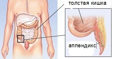 Баня после аппендицита