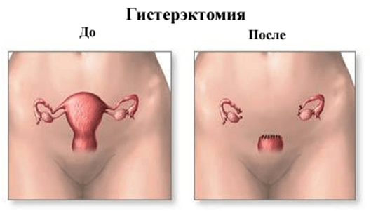 Баня после удаления матки