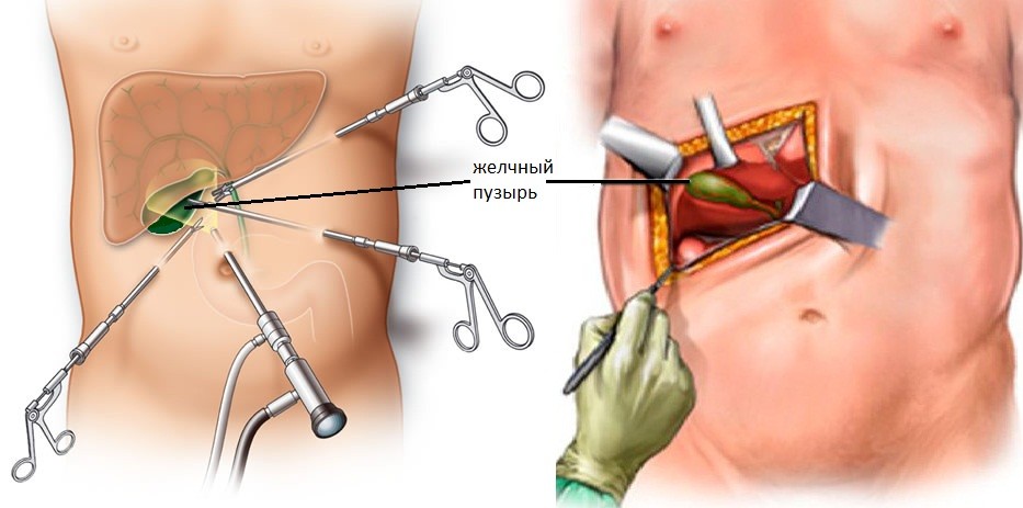 Баня после удаления желчного пузыря